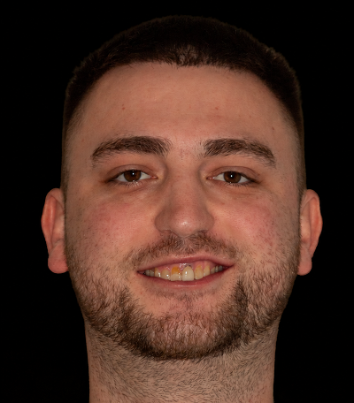 English Dental case: full-face photograph before treatment