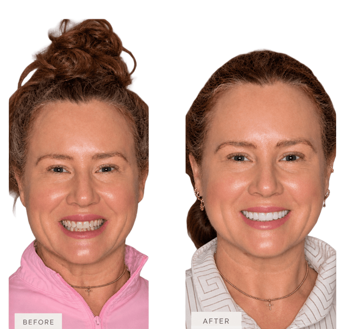 Smile makeover at English Dental in Louisville, KY