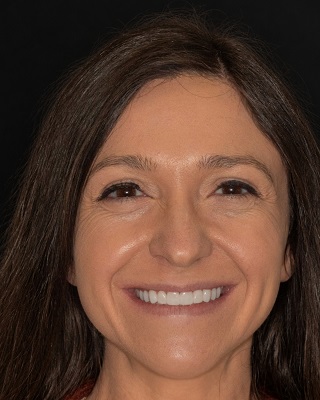 The same English Dental brunette case after treatment