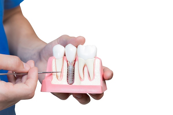 How Is A Dental Implant Placed?