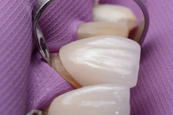 How To Care For Your Dental Veneers