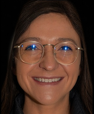 Before no-prep veneers: uneven tooth color and shape